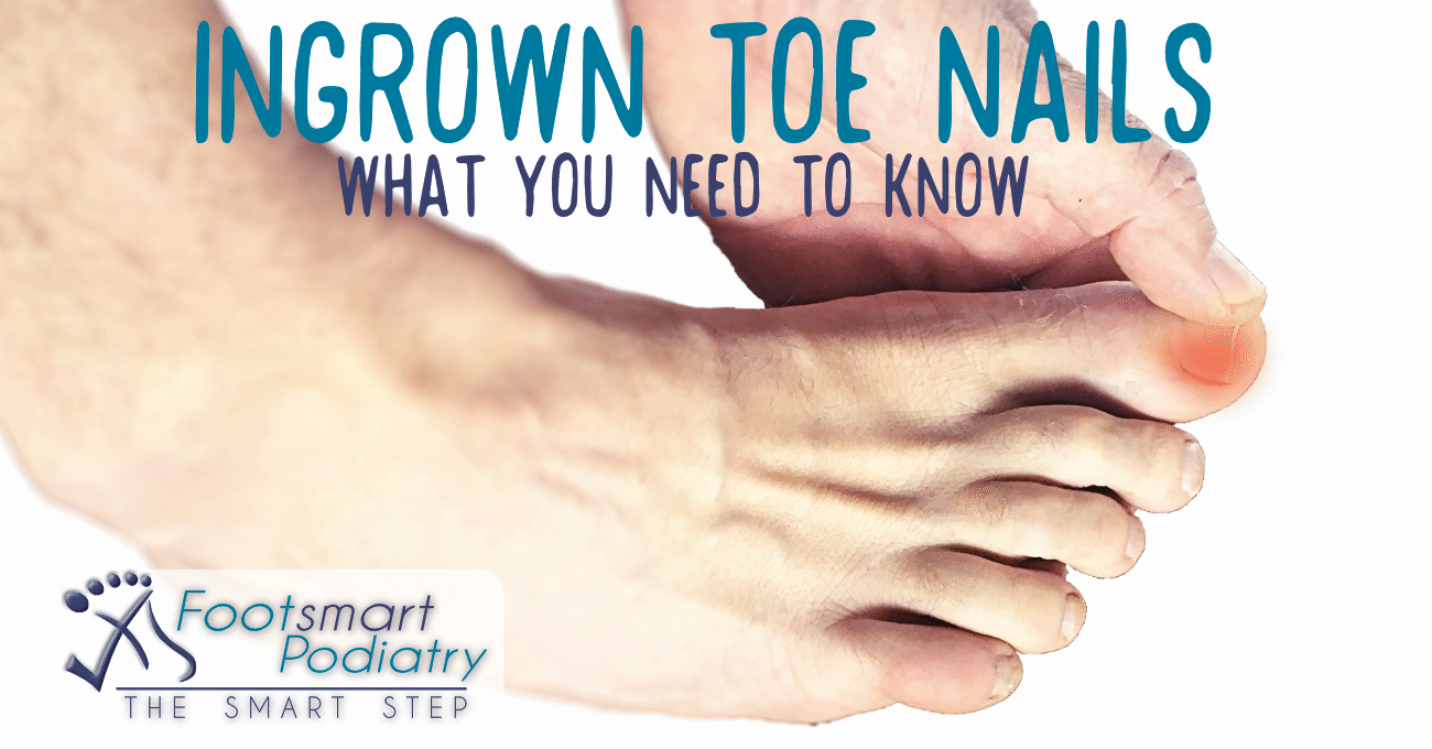 What causes Ingrown Toenails and how to treat them - Footsmart Podiatry