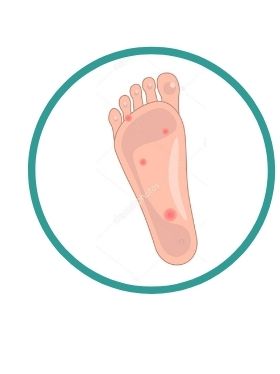 Blisters - General Podiatry Service