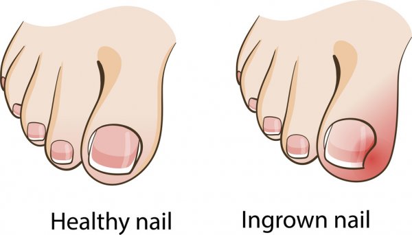 Pincer toe nails. — The Gait Guys