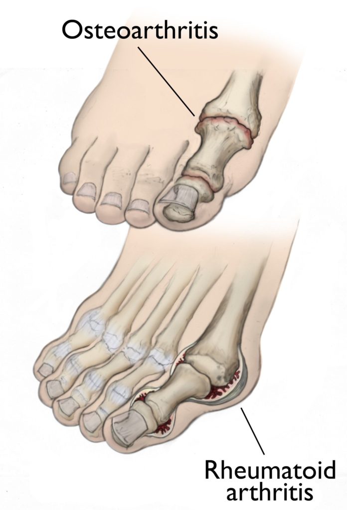 arthritis in the foot footsmart podiatry 
