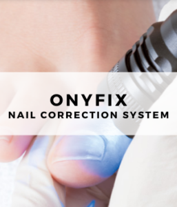 Onyfix ingrown toenail treatment Footsmart Podiatry