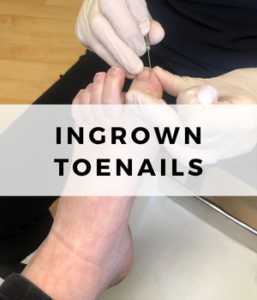 Ingrown toenails footsmart podiatry sunshine coast